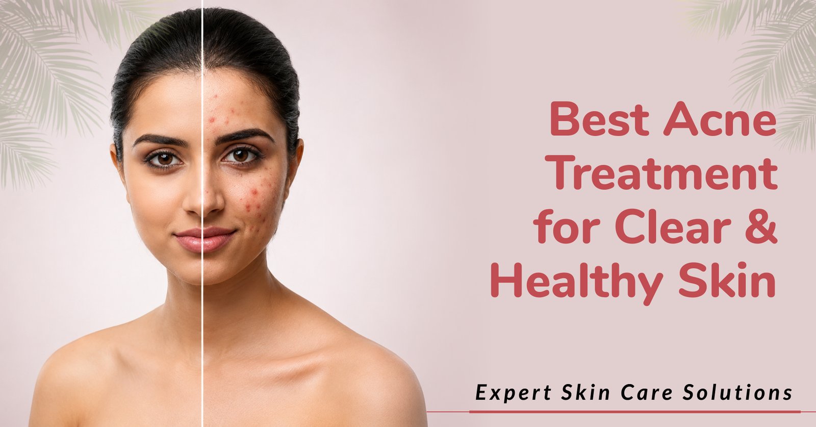 Best Acne Treatment for Clear & Healthy Skin